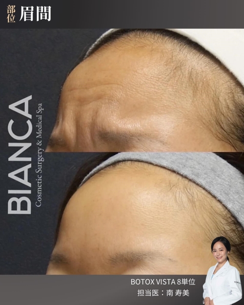 ボトックス（眉間）症例写真_ビフォーアフター_横